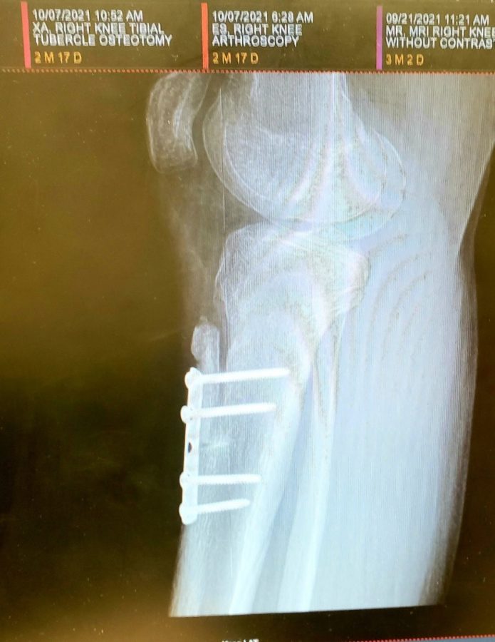  I underwent two tibial tubercle osteotomies within the span of four months. This surgery cut and shaped the bones in my shin and knee to change the anatomy of my legs from the waist down. I have a plate with four screws in each leg.

